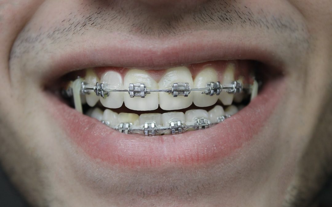 7 Signs You Might Need Orthodontic Treatment
