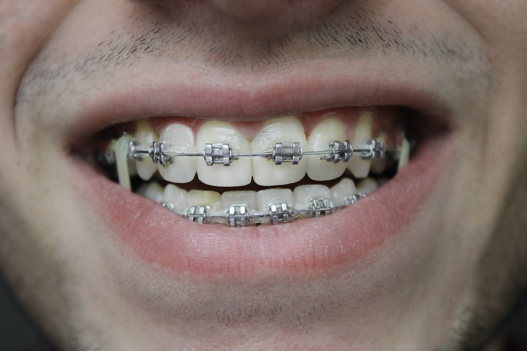 7 Signs You Might Need Orthodontic Treatment - Ross Orthodontics