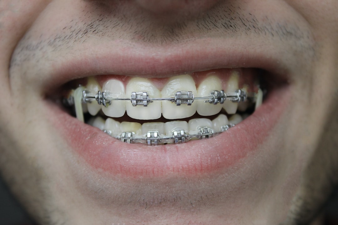 Braces