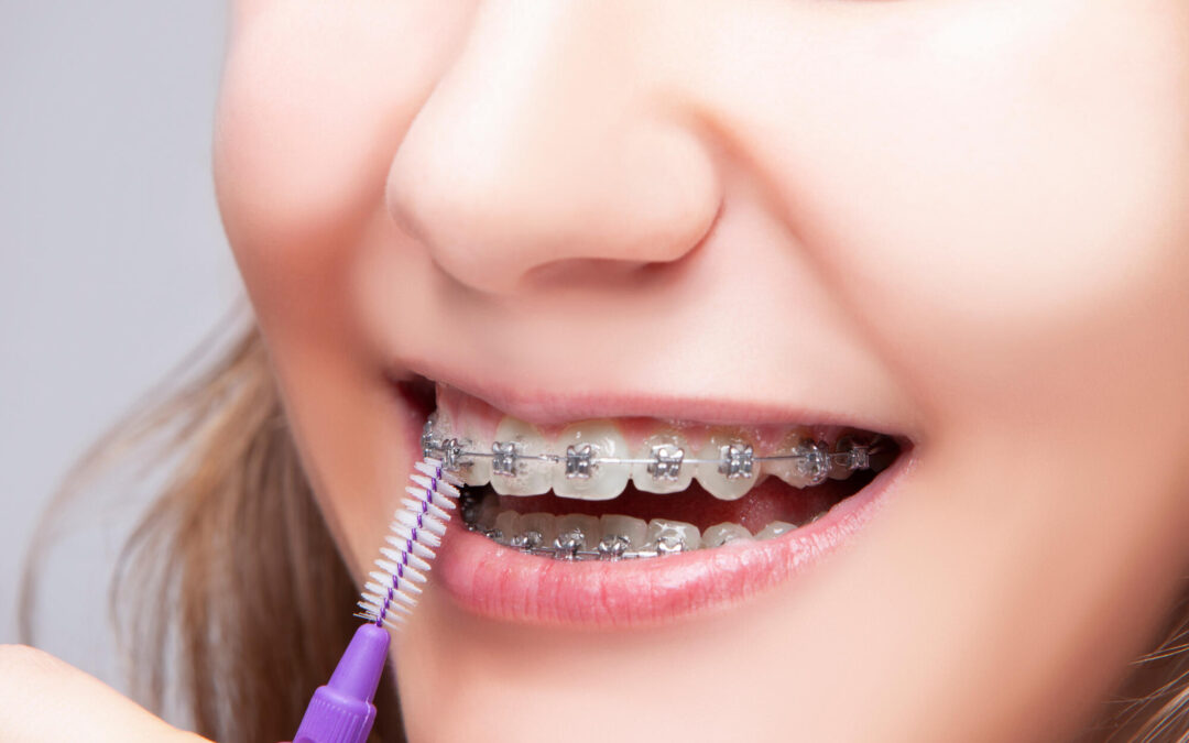 Beyond Straight Teeth: The Hidden Top 10 Benefits Of Teen Braces