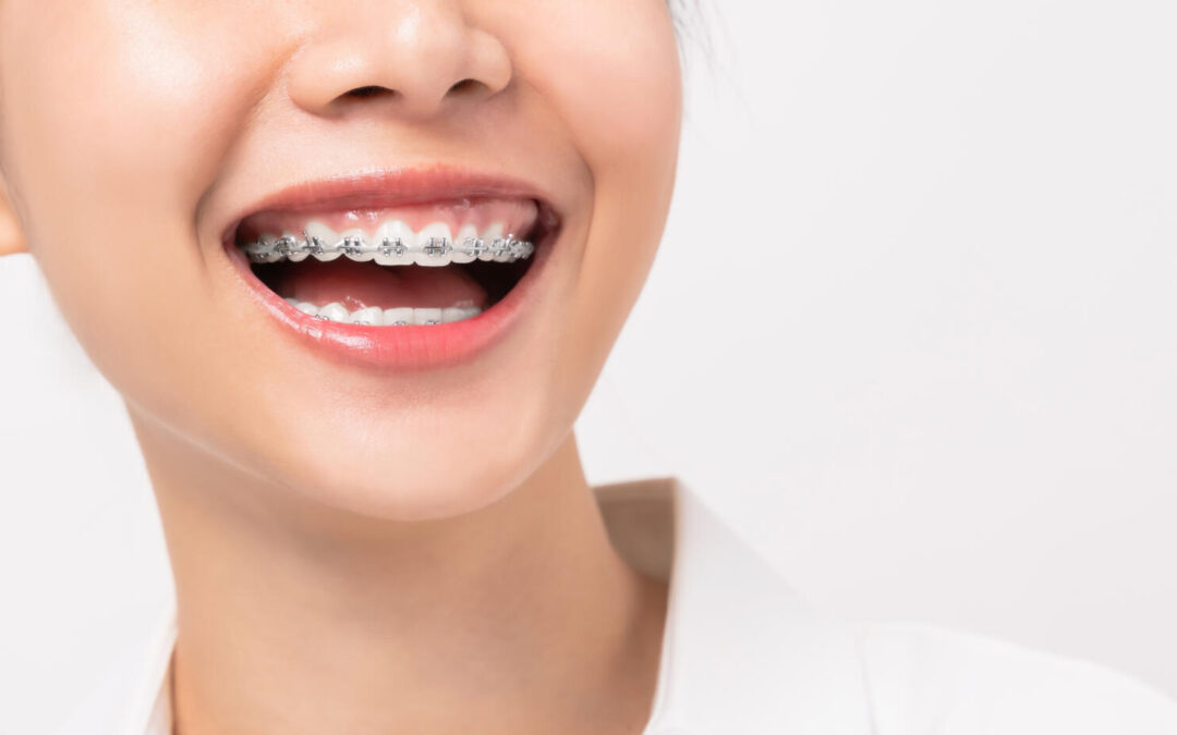 Are Braces Painful? Understanding the Experience